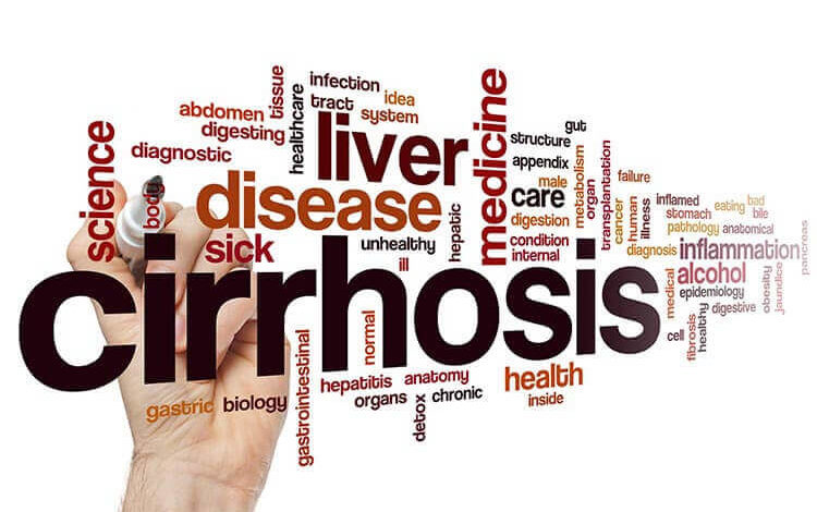 Alcoholic Liver Cirrhosis: Strictly An Alcohol-Driven Health Complication